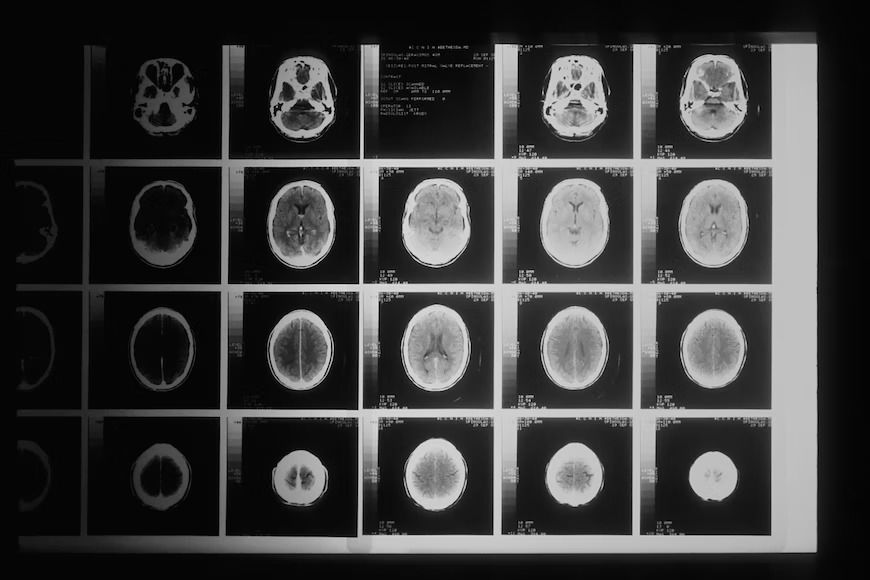Black and white MRI image featuring cross-section images of the human brain